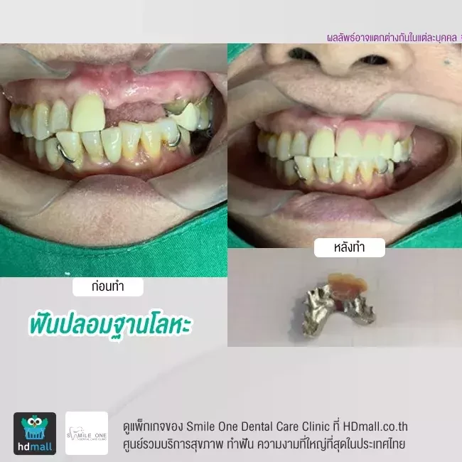 รีวิว ทำฟันปลอม ที่ Smile One Dental Care Clinic