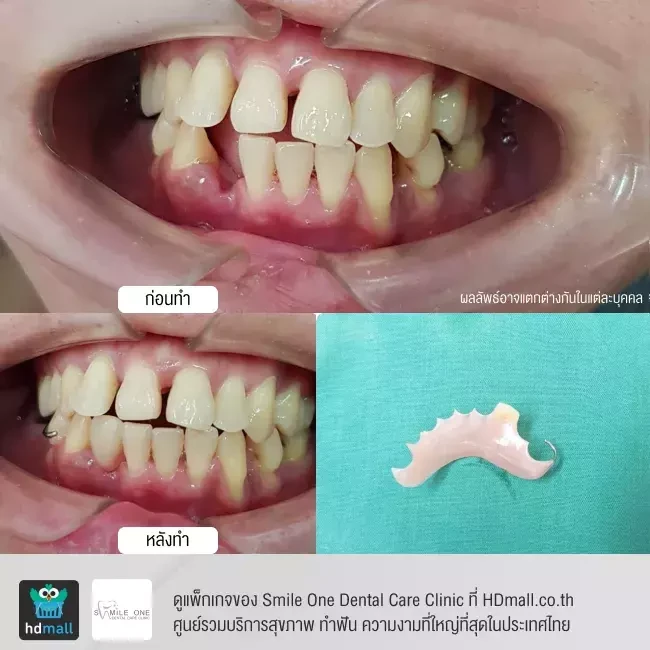 รีวิว ทำฟันปลอม ที่ Smile One Dental Care Clinic