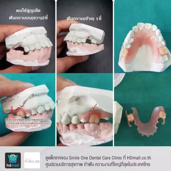 รีวิว ทำฟันปลอม ที่ Smile One Dental Care Clinic