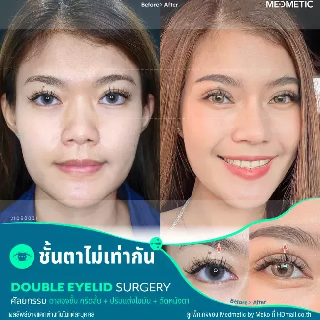 รีวิว ทำตาสองชั้น แบบกรีดสั้น ที่ Medmetic by Meko
