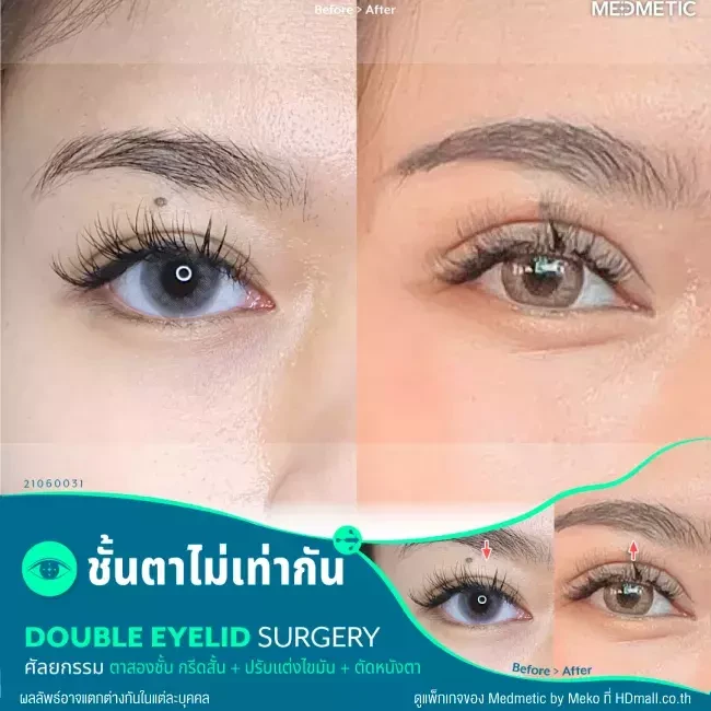 รีวิว ทำตาสองชั้น แบบกรีดสั้น ที่ Medmetic by Meko