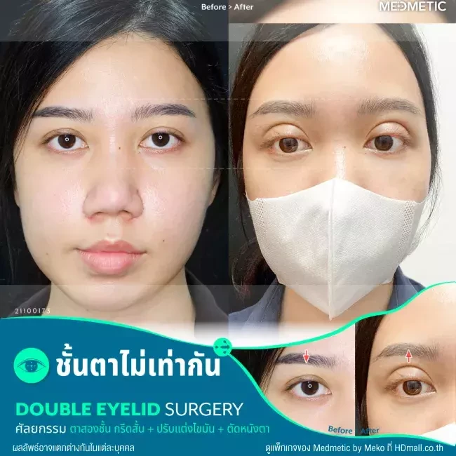 รีวิว ทำตาสองชั้น แบบกรีดสั้น ที่ Medmetic by Meko
