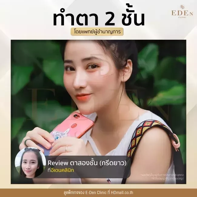 รีวิว ทำตาสองชั้น ที่ E-Den Clinic