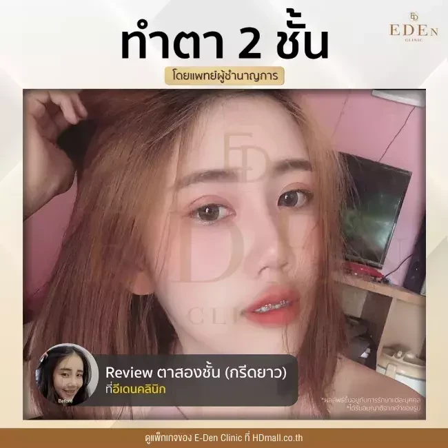 รีวิว ทำตาสองชั้น ที่ E-Den Clinic