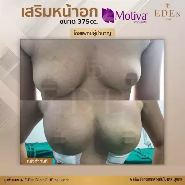 รีวิว เสริมหน้าอก ที่ E-Den Clinic