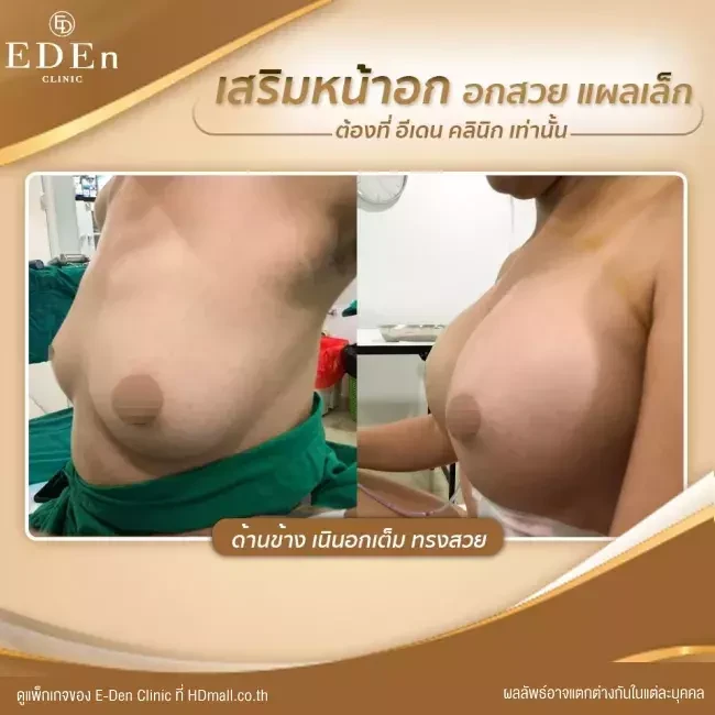 รีวิว เสริมหน้าอก ที่ E-Den Clinic