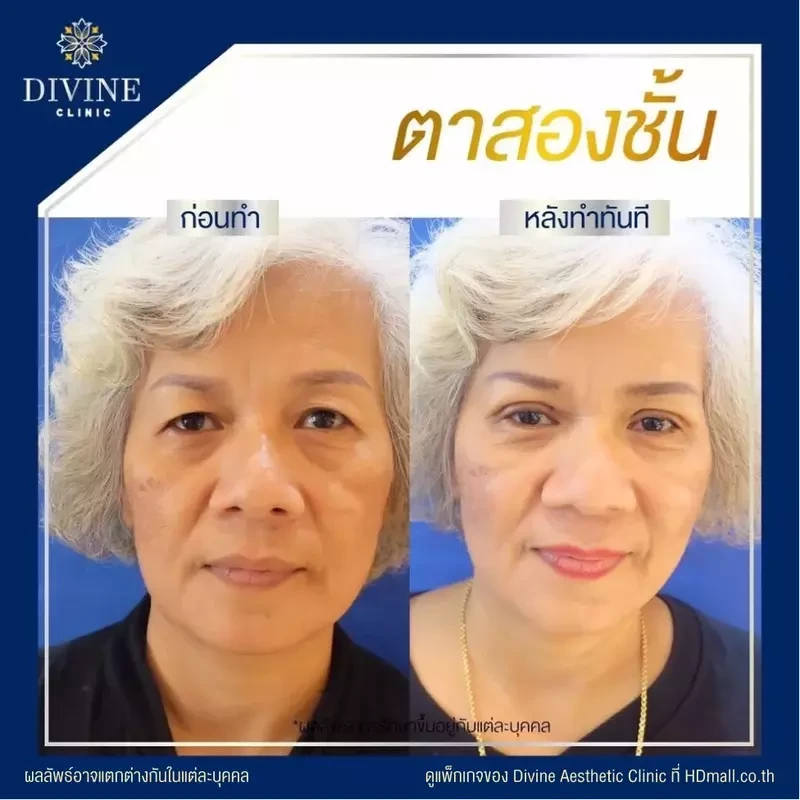 รีวิวทำตา 2 ชั้น ที่ Divine Aesthetic Clinic
