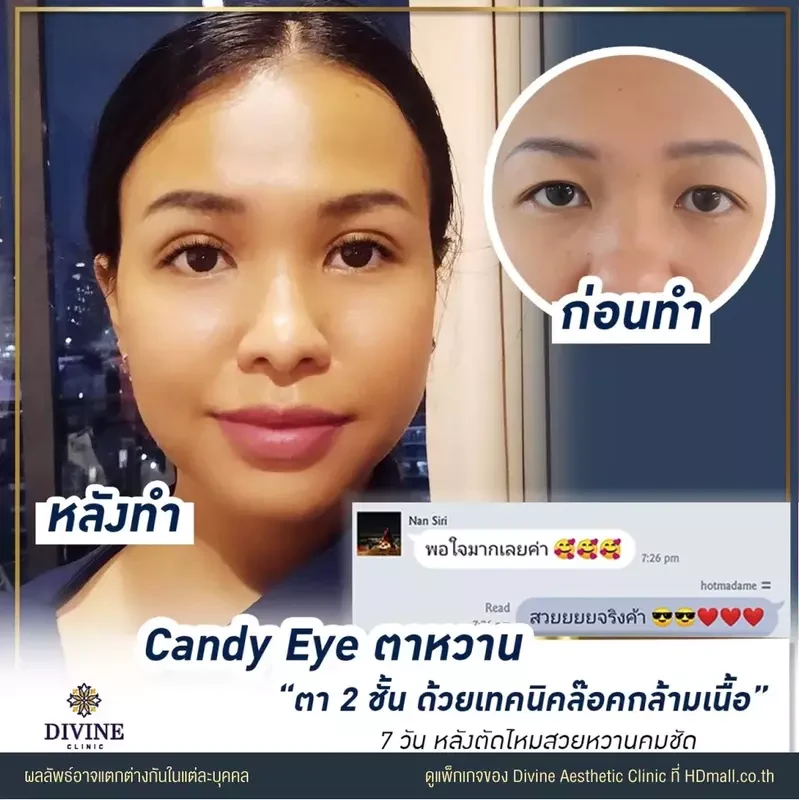 รีวิวทำตา 2 ชั้น ที่ Divine Aesthetic Clinic