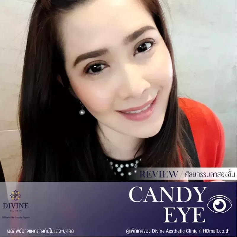 รีวิวทำตา 2 ชั้น ที่ Divine Aesthetic Clinic