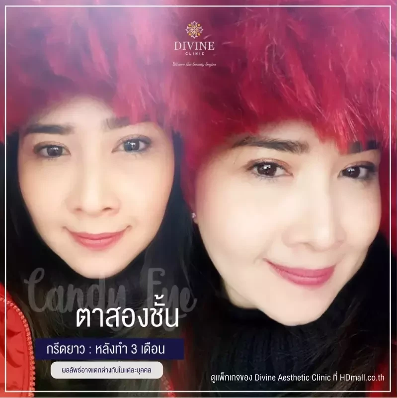 รีวิวทำตา 2 ชั้น ที่ Divine Aesthetic Clinic