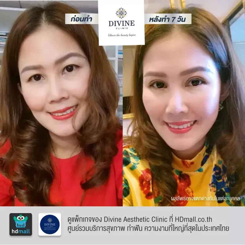รีวิวทำตา 2 ชั้น ที่ Divine Aesthetic Clinic