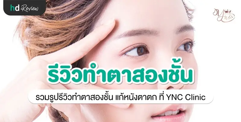 รีวิว ทำตาสองชั้น แก้หนังตาตก ที่ YNC Clinic
