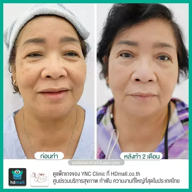 Before After ทำตาสองชั้น แก้หนังตาตก ที่ YNC Clinic