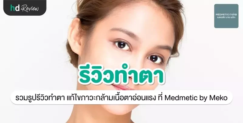 รีวิว ทำตา แก้ไขภาวะกล้ามเนื้อตาอ่อนแรง ที่ Medmetic by Meko