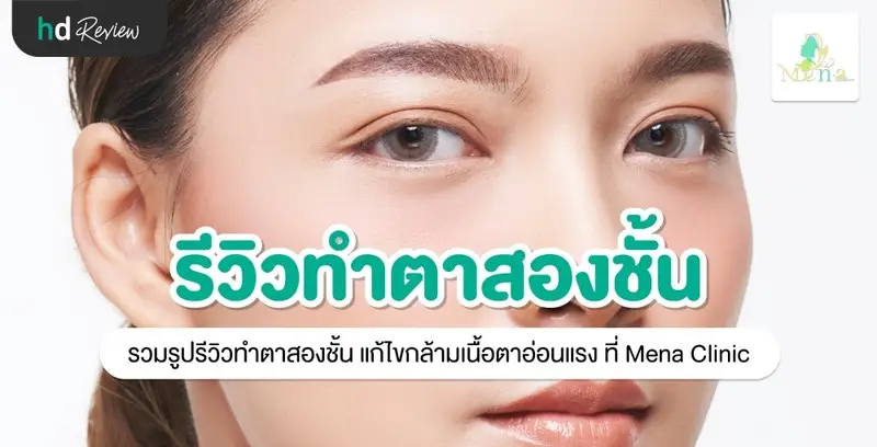 รีวิว ทำตาสองชั้น แก้ไขกล้ามเนื้อตาอ่อนแรง ที่ Mena Clinic