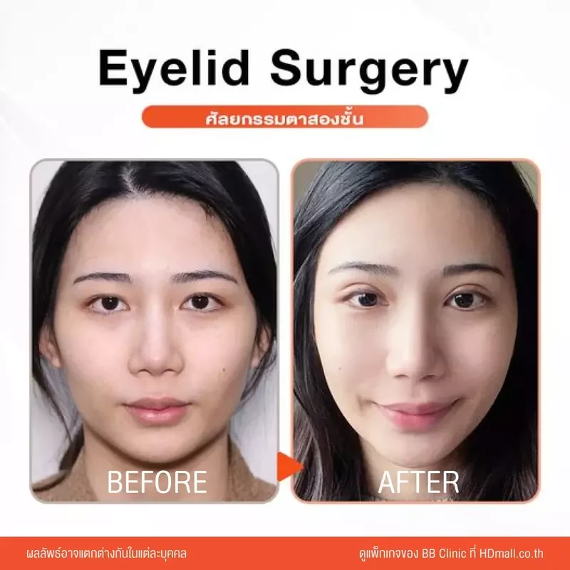 รีวิว ทำตาสองชั้น ที่ BB Clinic