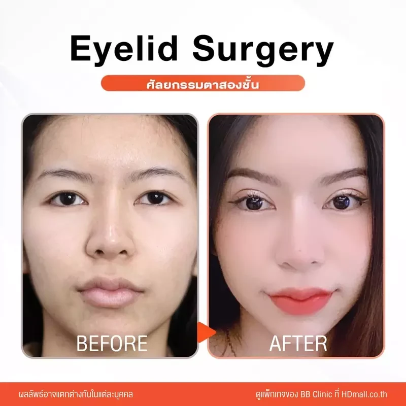 รีวิว ทำตาสองชั้น ที่ BB Clinic