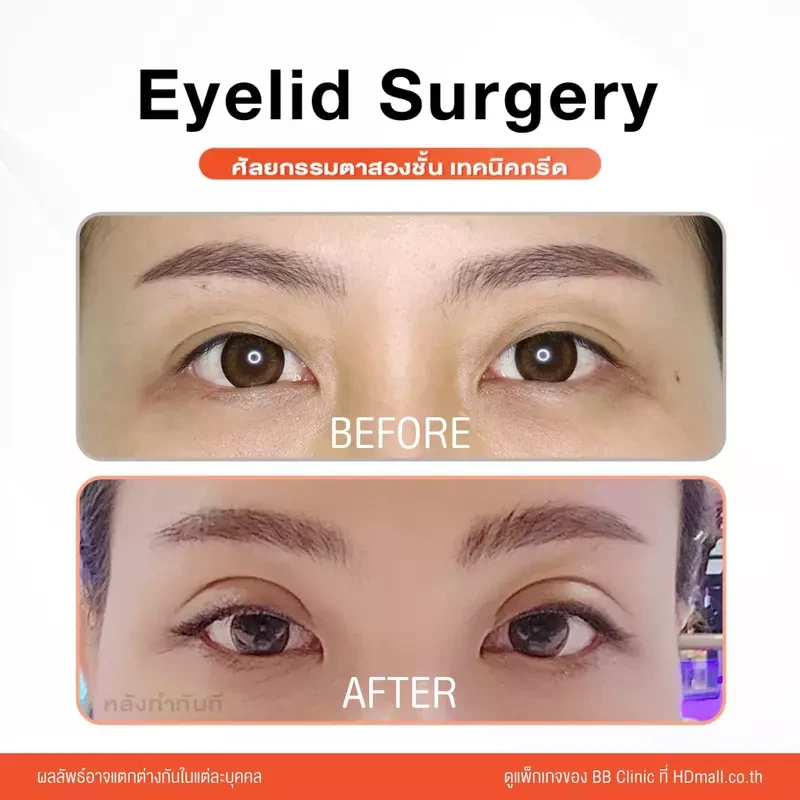 รีวิว ทำตาสองชั้น ที่ BB Clinic