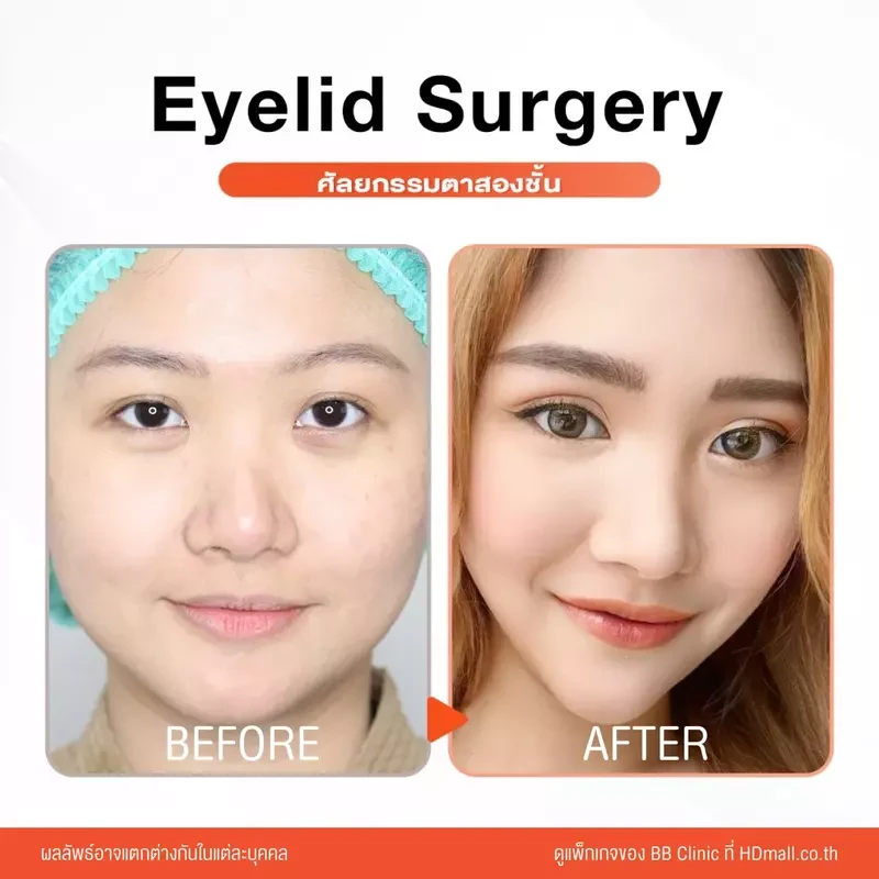รีวิว ทำตาสองชั้น ที่ BB Clinic