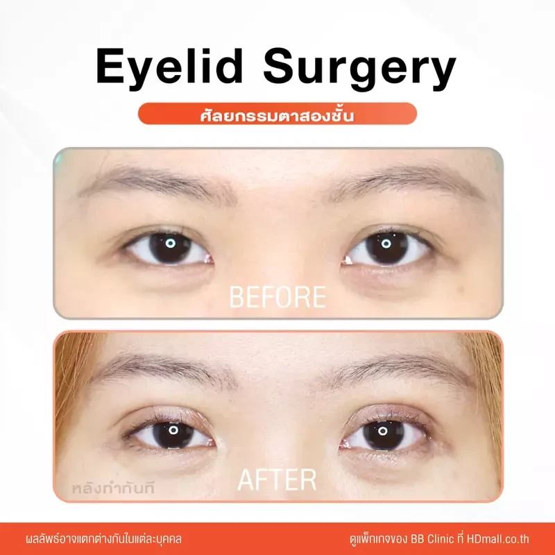 รีวิว ทำตาสองชั้น ที่ BB Clinic