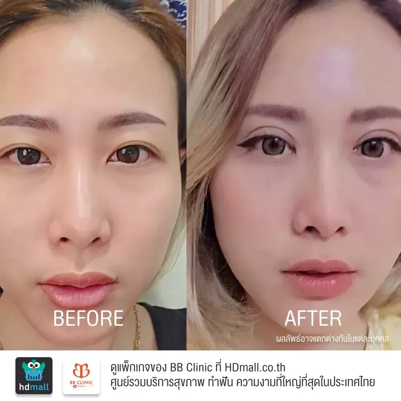 รีวิว ทำตาสองชั้น ที่ BB Clinic
