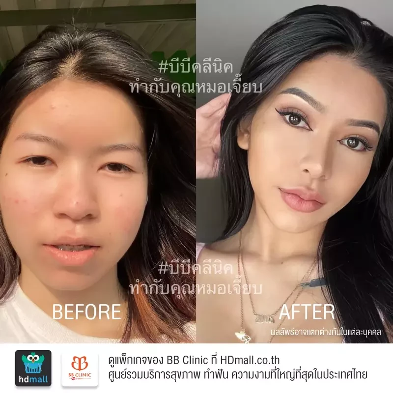 รีวิว ทำตาสองชั้น ที่ BB Clinic