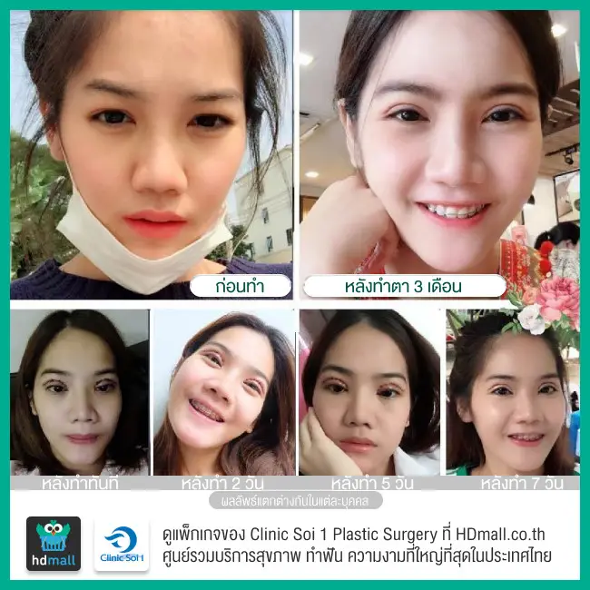 รีวิว ทำตาสองชั้น ที่ Clinic Soi 1 Plastic Surgery