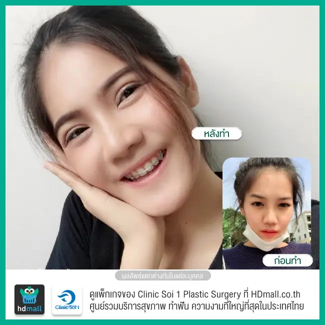 รีวิว ทำตาสองชั้น ที่ Clinic Soi 1 Plastic Surgery
