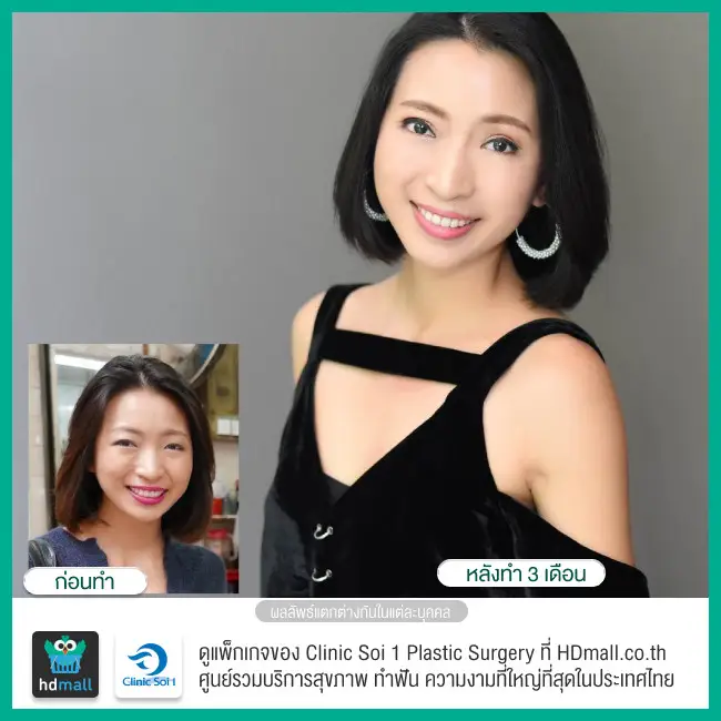 รีวิว ทำตาสองชั้น ที่ Clinic Soi 1 Plastic Surgery