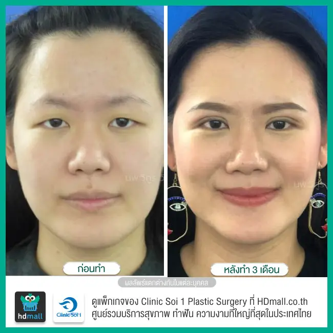 รีวิว ทำตาสองชั้น ที่ Clinic Soi 1 Plastic Surgery