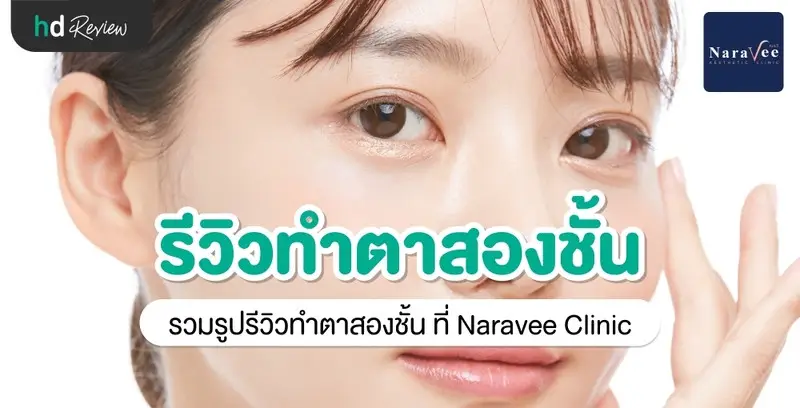 รีวิว ทำตาสองชั้น ที่ Naravee Clinic (ณรวีคลินิก)