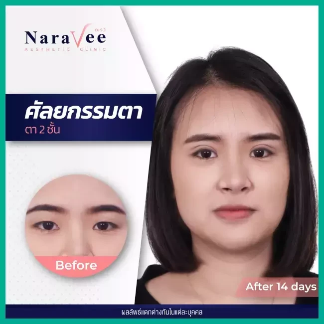 Before After รีวิว ทำตาสองชั้น ที่ Naravee Clinic (ณรวีคลินิก)