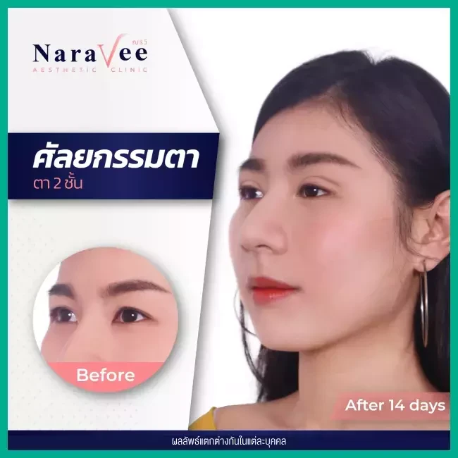 Before After รีวิว ทำตาสองชั้น ที่ Naravee Clinic (ณรวีคลินิก)