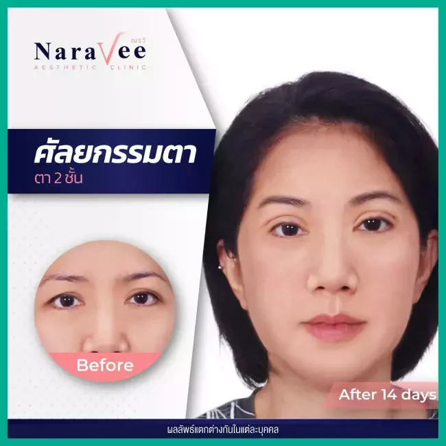 Before After รีวิว ทำตาสองชั้น ที่ Naravee Clinic (ณรวีคลินิก)