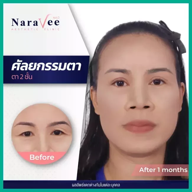 Before After รีวิว ทำตาสองชั้น ที่ Naravee Clinic (ณรวีคลินิก)