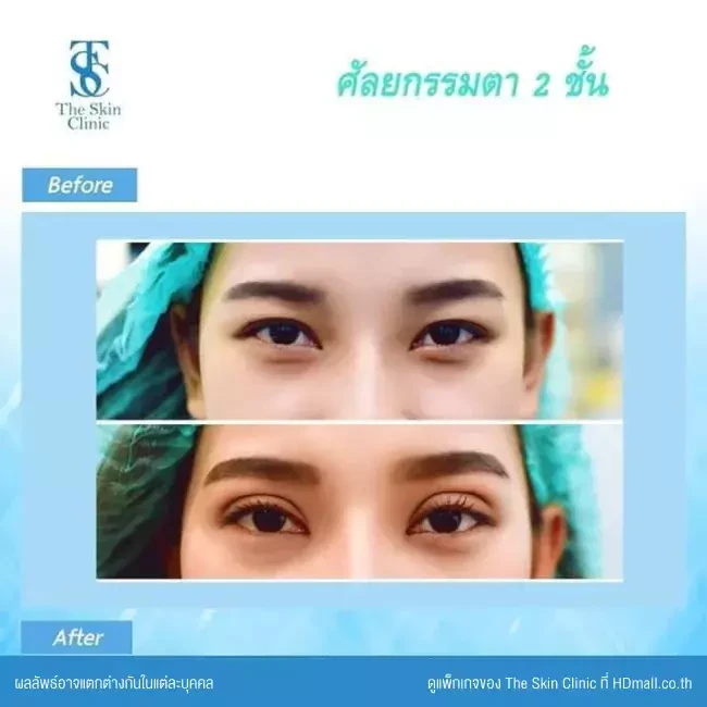 รีวิว ทำตาสองชั้น ที่ The Skin Clinic