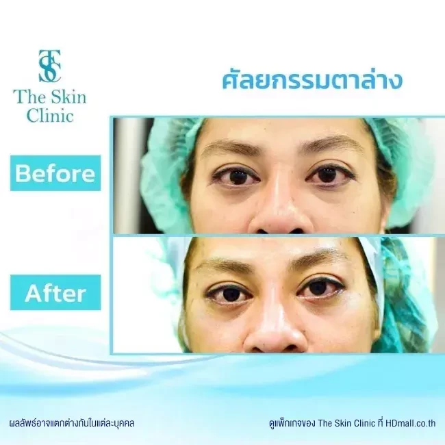 รีวิว ทำตาสองชั้น ที่ The Skin Clinic