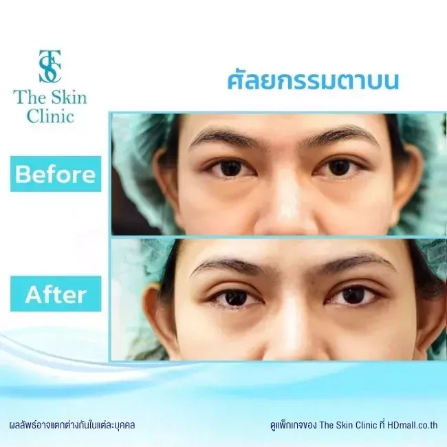 รีวิว ทำตาสองชั้น ที่ The Skin Clinic