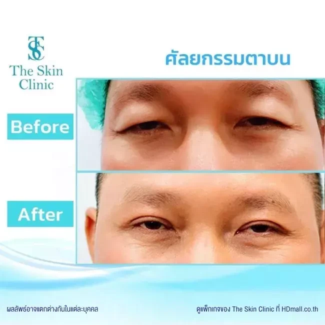 รีวิว ทำตาสองชั้น ที่ The Skin Clinic