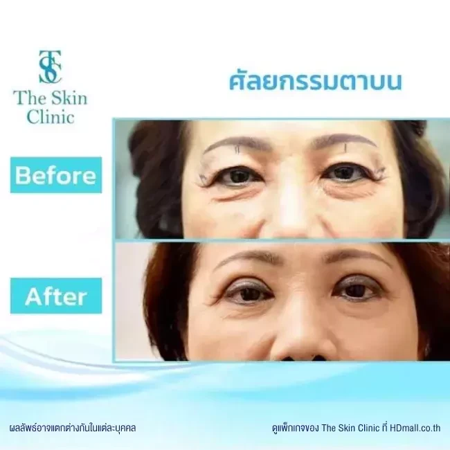 รีวิว ทำตาสองชั้น ที่ The Skin Clinic