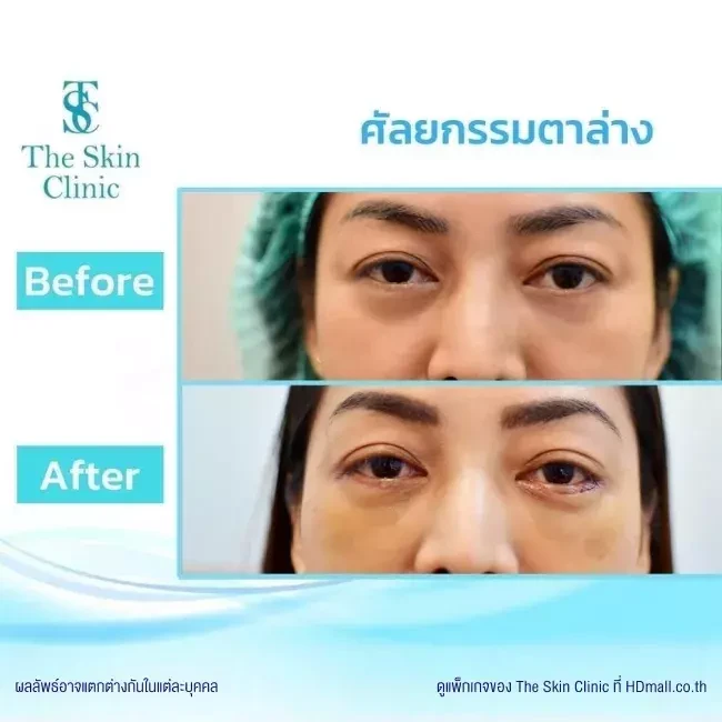 รีวิว ทำตาสองชั้น ที่ The Skin Clinic