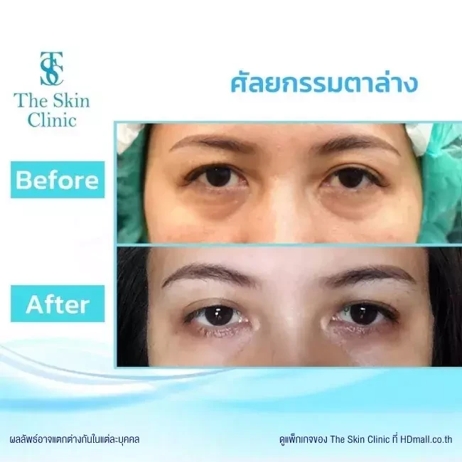 รีวิว ทำตาสองชั้น ที่ The Skin Clinic