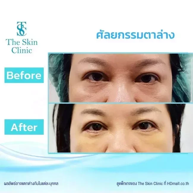 รีวิว ทำตาสองชั้น ที่ The Skin Clinic