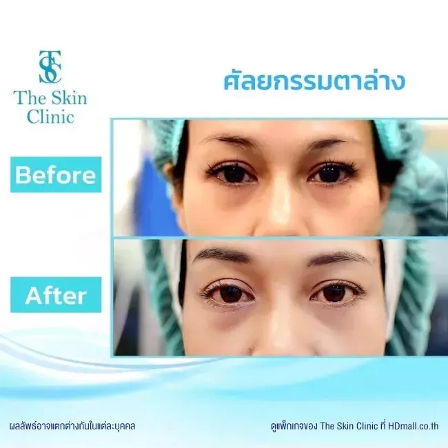 รีวิว ทำตาสองชั้น ที่ The Skin Clinic