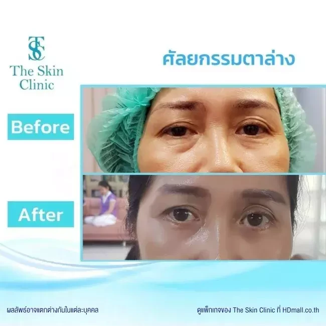 รีวิว ทำตาสองชั้น ที่ The Skin Clinic