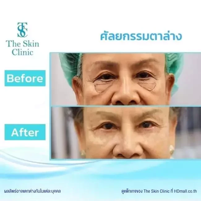 รีวิว ทำตาสองชั้น ที่ The Skin Clinic