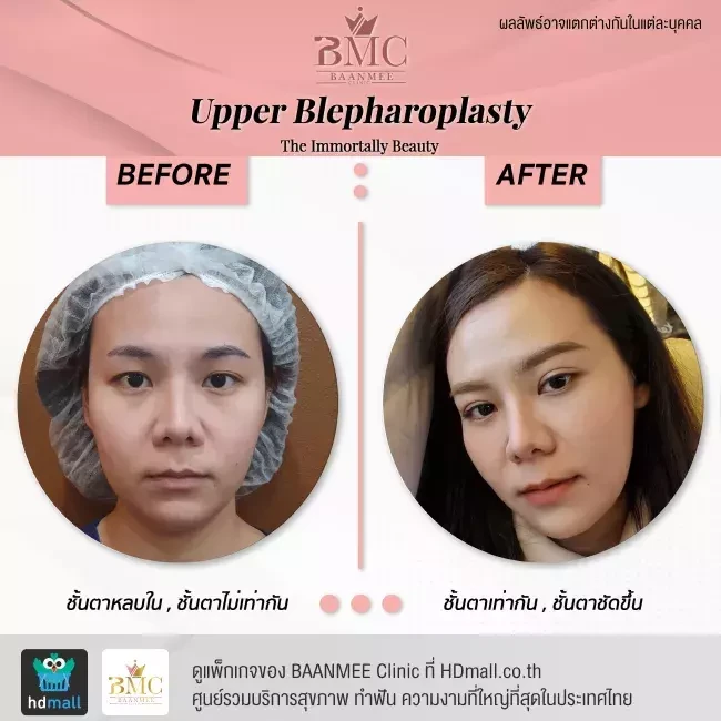 รีวิว ทำตาสองชั้น ที่ BAANMEE Clinic (บ้านหมีคลินิก)