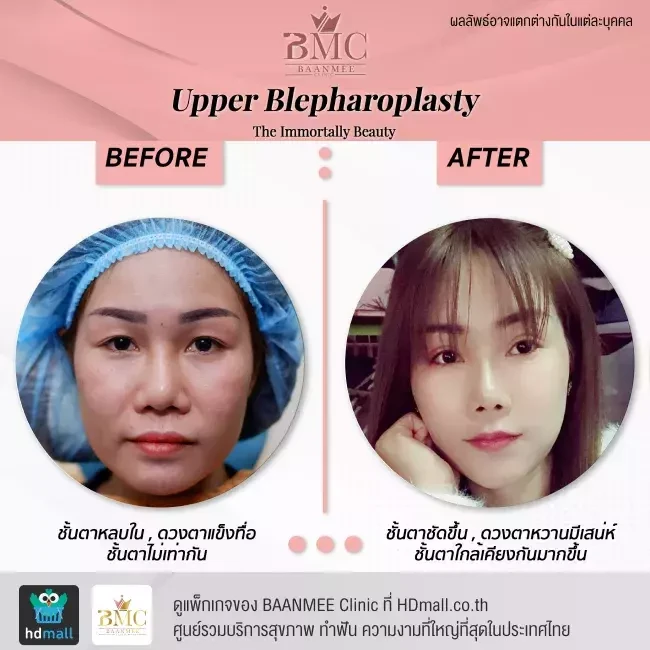 รีวิว ทำตาสองชั้น ที่ BAANMEE Clinic (บ้านหมีคลินิก)