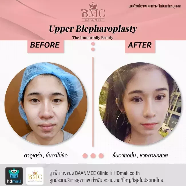 รีวิว ทำตาสองชั้น ที่ BAANMEE Clinic (บ้านหมีคลินิก)