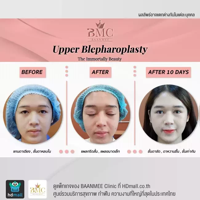 รีวิว ทำตาสองชั้น ที่ BAANMEE Clinic (บ้านหมีคลินิก)